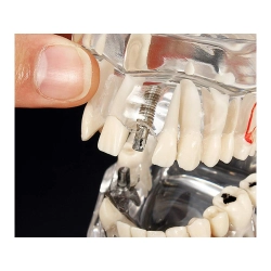 Model stomatologiczny szczęka zęby zębow implanty