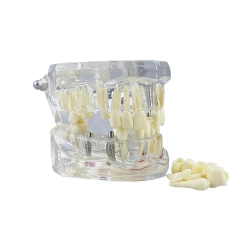 Model stomatologiczny szczęka zęby zębow implanty