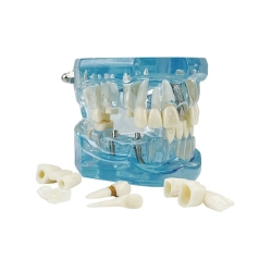 Model stomatologiczny szczęka zęby zębow implanty