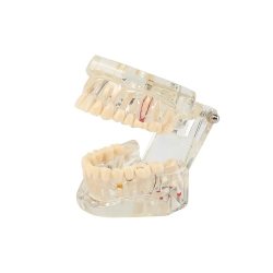 Model stomatologiczny szczęka zęby zębow implanty