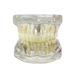 Model stomatologiczny szczęka zęby zębow implanty