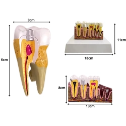 Model anatomiczny zęba stomatologiczny edukacyjny przekrój wyjmowany ząb