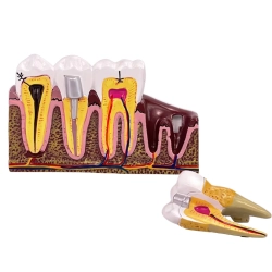 Model anatomiczny zęba stomatologiczny edukacyjny przekrój wyjmowany ząb