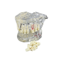 Model stomatologiczny szczęka zęby zębow implanty