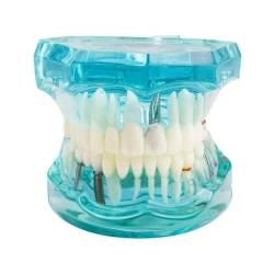 Model stomatologiczny szczęka zęby zębow implanty