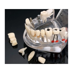 Model stomatologiczny szczęka zęby zębow implanty